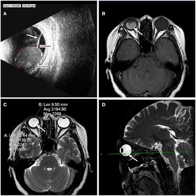 Case report: An intraretinal macrocyst with crystalline content and retinal detachment